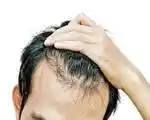 Hair Loss Medications